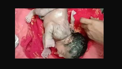 به دنیا آمدن نوزادی با ۳ دست همه را به تعجب واداشت