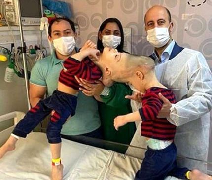دوقلوهای به هم چسبیده برزیلی در عمل ۲۷ ساعته جدا شدند
