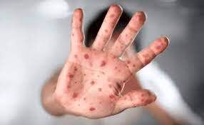 شباهت علائم آبله میمونی و آبله مرغان / نحوه نمونه گیری از افراد مشکوک به بیماری
