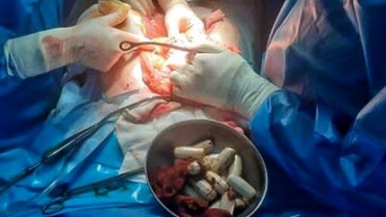 ۱۰۰ بسته مواد مخدر جاسازی شده از بدن یک جوان ۲۲ ساله خارج شد