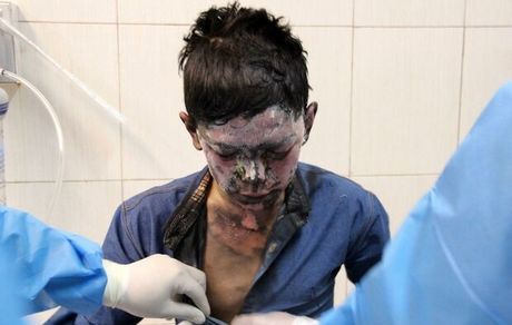 کودک ۱۲ ساله اولین مصدوم حوادث چهارشنبه سوری استان یزد